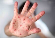 zdravstveni radnici i cijepljenje djece MMR cjepivom zbog pojave morbila u HNŽ